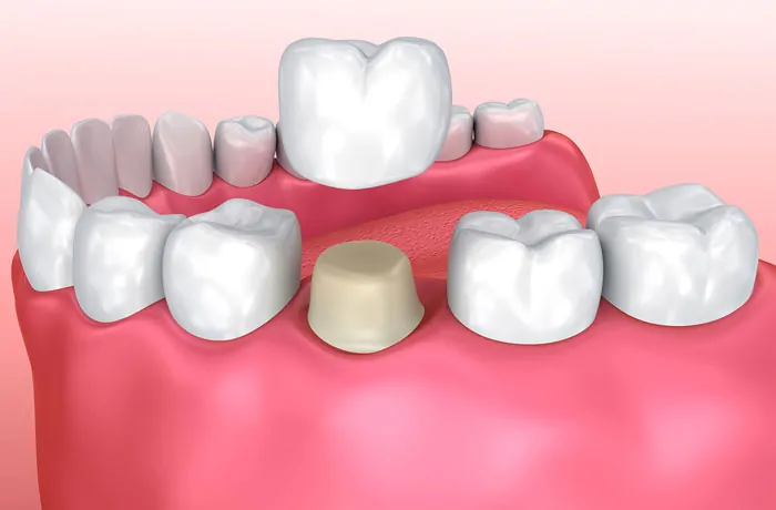 Cerec Crowns Grandville Mi Dentist
