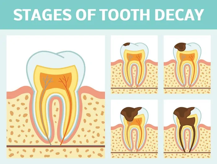 Dental Crowns Grandville Mi Dentist